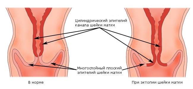 Эпителий шейки матки. Эктопия цилиндрического эпителия. Эктопия цилиндрического эпителия и эрозия. Цилиндрический эпителий цервикального канала. Цилиндрический эпителий шейка матки.