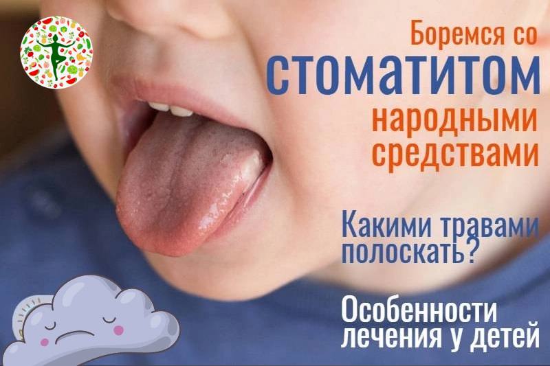 Что такое стоматит у детей чем лечить. Что такое стоматит у детей чем лечить. Памятка по профилактике стоматита. Герпесный стоматит препараты. От стоматита во рту у детей лекарство.