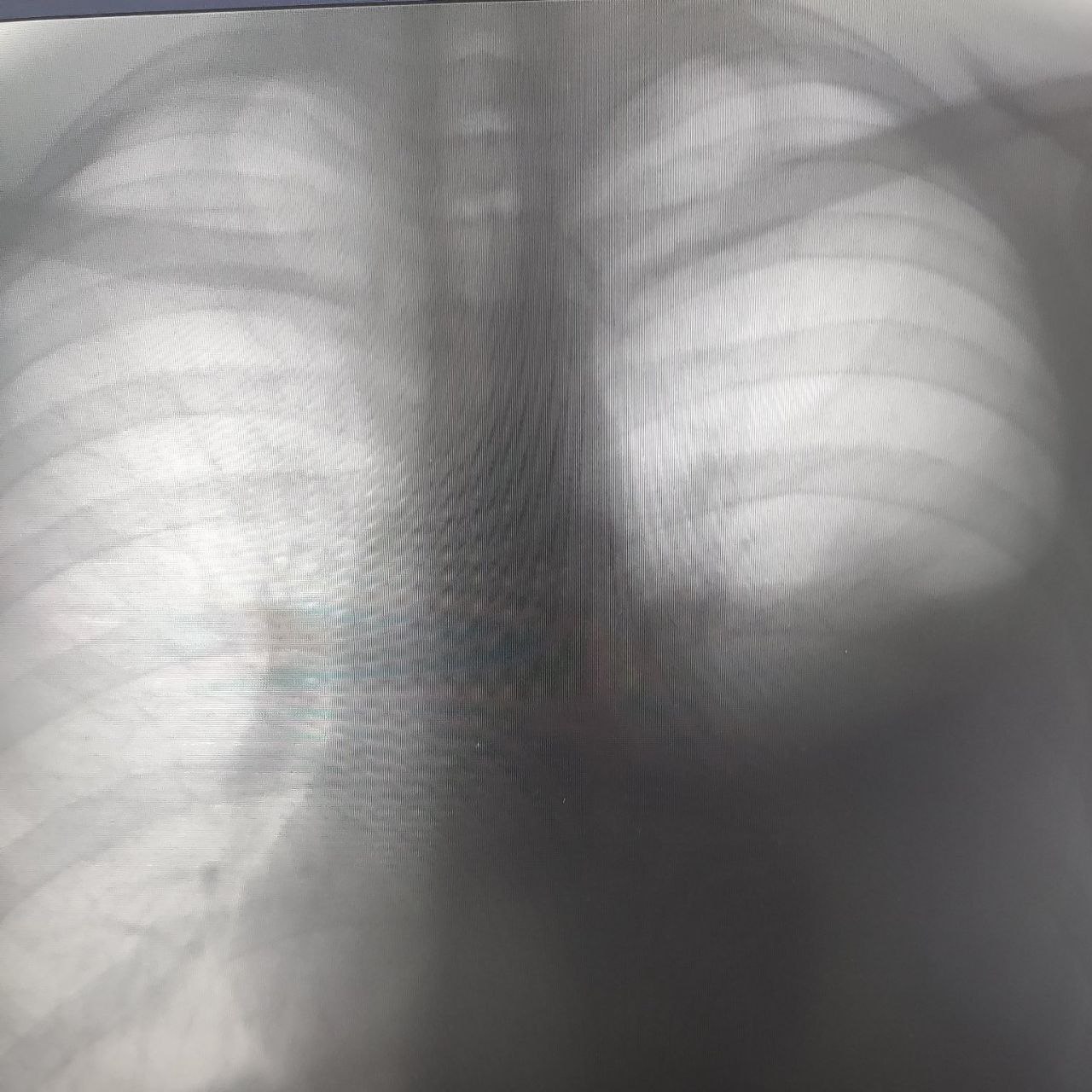 силиконовая грудь на рентгене фото 107