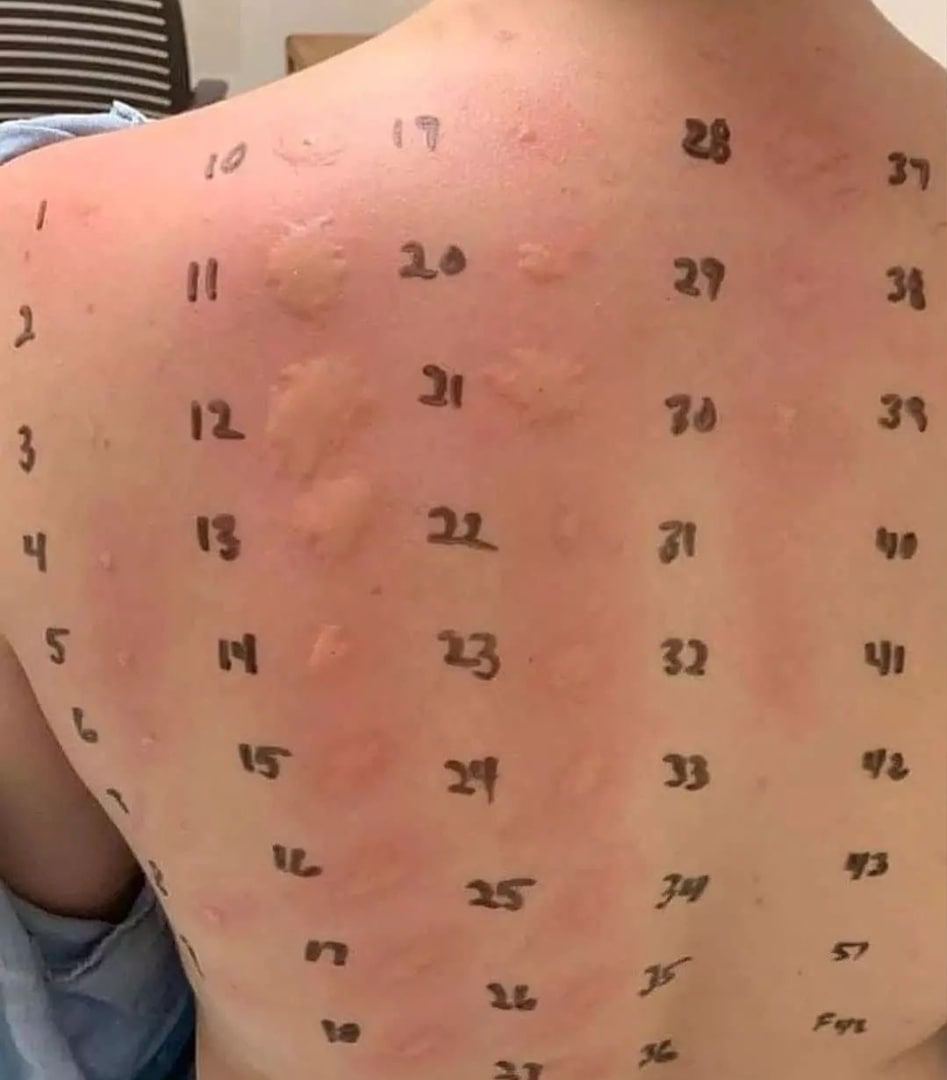 аллергический спиной фото